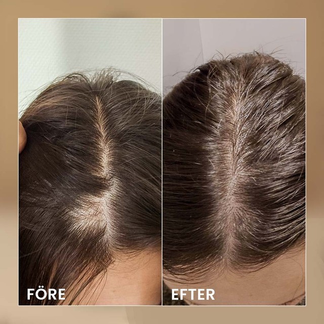 BIOELIXIR-SCALP----prije-posle---SWE